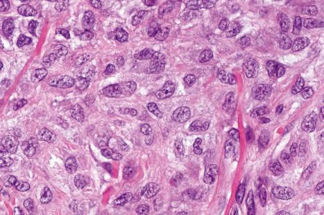 Fig. 33.65, Myoepithelioma: the tumor cells have eosinophilic cytoplasm and round to oval or spindled vesicular nuclei with prominent nucleoli.