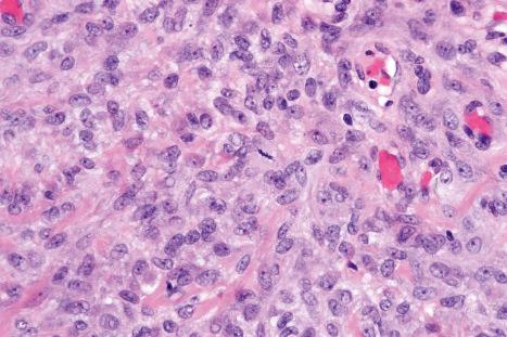 Fig. 33.66, Myoepithelioma: a mitosis is present in the center of the field.