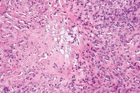 Fig. 33.67, Myoepithelioma: in this field, there is marked stromal hyalinization.