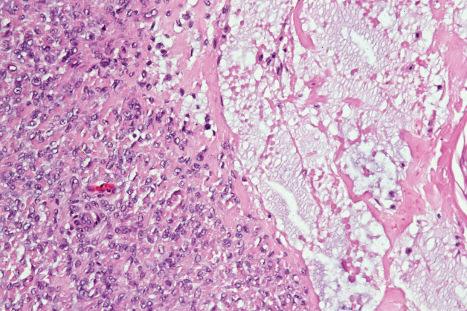 Fig. 33.68, Myoepithelioma: myxoid change, as shown in this field, is sometimes present.