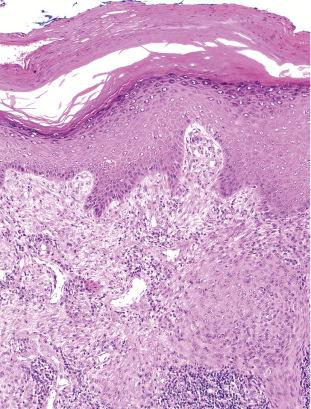 Fig. 33.69, Syncytial myoepithelioma: dermal tumor composed of sheets of pale eosinophilic cells. There is inflammation in the background.