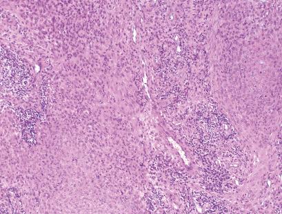 Fig. 33.70, Syncytial myoepithelioma: ovoid or slightly elongated cells with syncytial pale eosinophilic cytoplasm and vesicular nuclei with a small nucleolus.