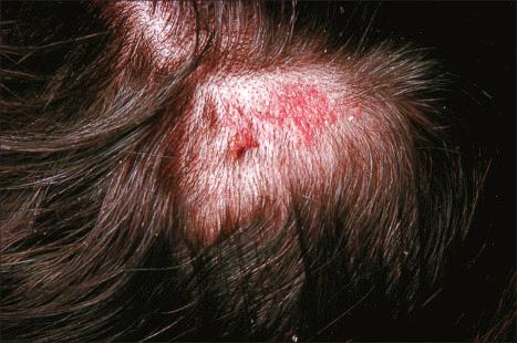 Fig. 33.7, Syringocystadenoma papilliferum: scalp tumor, which has arisen within a nevus sebaceous.