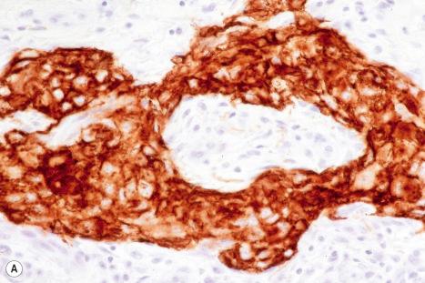 Fig. 33.71, Myoepithelioma: immunohistochemistry showing ( A ) EMA, ( B ) S100 protein, ( C ) smooth muscle actin, and ( D ) GFAP expression.