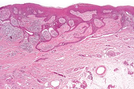 Fig. 33.72, Eccrine syringofibroadenoma: this lesion presented as a solitary tumor. Arising from the epidermis are numerous anastomosing strands of epithelium surrounded by a cellular fibrous stroma.