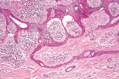 Fig. 33.73, Eccrine syringofibroadenoma: the epithelium is composed of uniform small cells with eosinophilic cytoplasm and small hyperchromatic nuclei. Ductal differentiation is present.