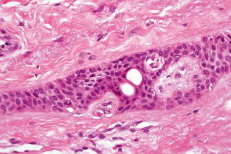 Fig. 33.74, Eccrine syringofibroadenoma: high-power view.