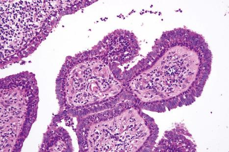 Fig. 33.9, Syringocystadenoma papilliferum: the papillae are covered by an outer layer of tall columnar cells with eosinophilic cytoplasm and an inner layer of small cuboidal myoepithelial cells with hyperchromatic nuclei.