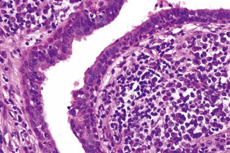 Fig. 33.10, Syringocystadenoma papilliferum: the stroma contains numerous plasma cells.