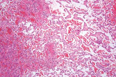 Fig. 1, Intravascular papillary endothelial hyperplasia.