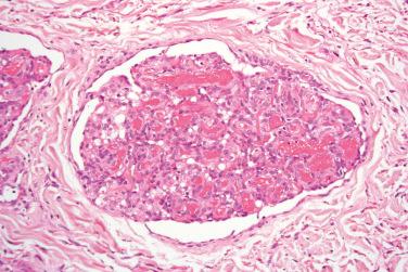 Fig. 3, Glomeruloid hemangioma.