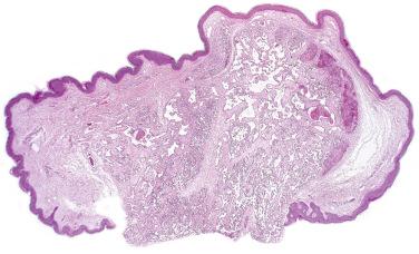 Fig. 1, Papillary hemangioma.