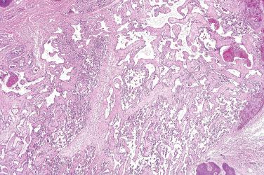 Fig. 2, Papillary hemangioma.