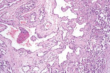 Fig. 3, Papillary hemangioma.