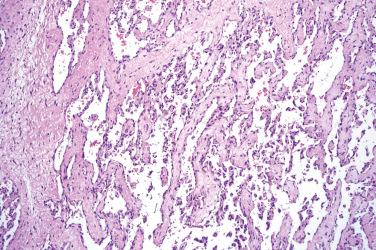 Fig. 4, Papillary hemangioma.