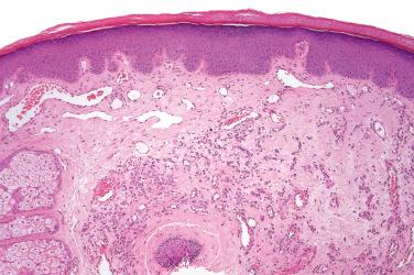 Fig. 1, Nevus flammeus.