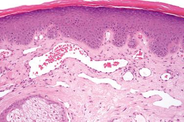 Fig. 2, Nevus flammeus.