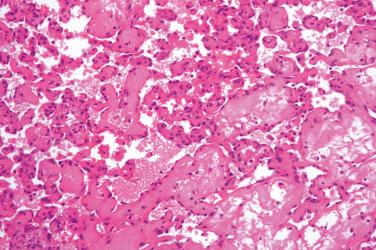 Fig. 2, Intravascular papillary endothelial hyperplasia.