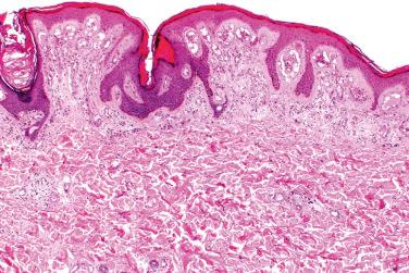 Fig. 1, Angioma serpiginosum.