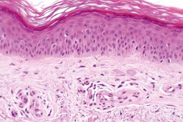 Fig. 1, Cutaneous collagenous vasculopathy.