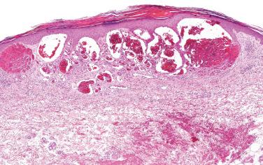 Fig. 1, Angiokeratoma.