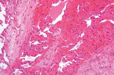 Fig. 3, Intravascular papillary endothelial hyperplasia.