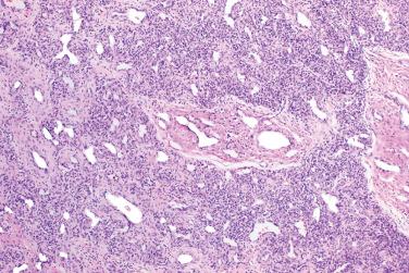 Fig. 2, Rapidly involuting congenital hemangioma.