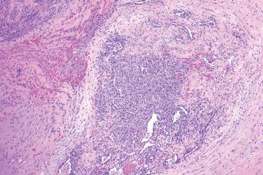 Fig. 4, Rapidly involuting congenital hemangioma.