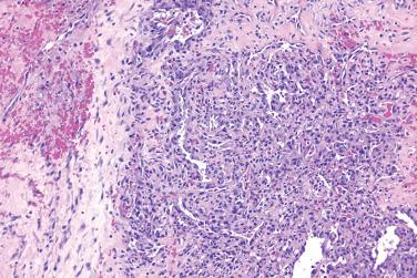 Fig. 5, Rapidly involuting congenital hemangioma.