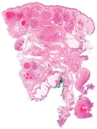 Fig. 1, Noninvoluting congenital hemangioma.