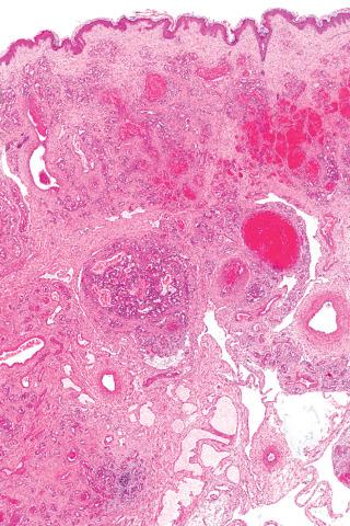 Fig. 2, Noninvoluting congenital hemangioma.