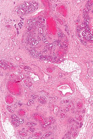 Fig. 3, Noninvoluting congenital hemangioma.