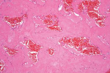 Fig. 4, Intravascular papillary endothelial hyperplasia.