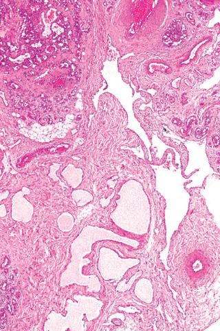 Fig. 4, Noninvoluting congenital hemangioma.