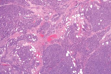 Fig. 1, Infantile hemangioma