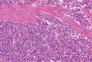 Fig. 3, Infantile hemangioma