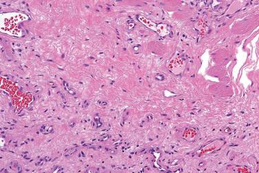 Fig. 8, Infantile hemangioma