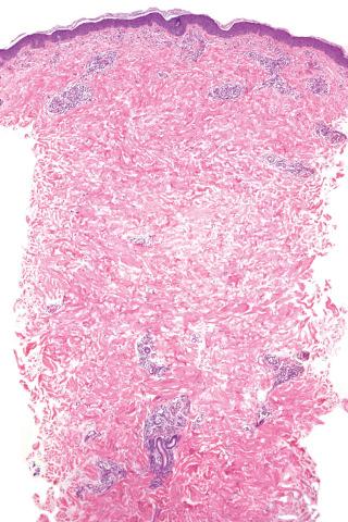 Fig. 1, Reactive angioendotheliomatosis.