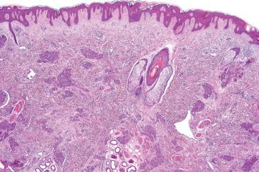 Fig. 1, Tufted angioma.