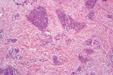 Fig. 2, Tufted angioma.