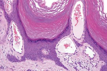 Fig. 2, Verrucous venous malformation.