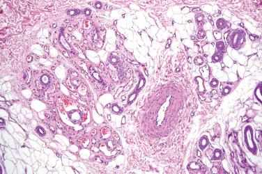 Fig. 3, Verrucous venous malformation.