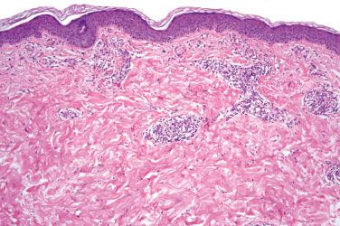 Fig. 2, Reactive angioendotheliomatosis.