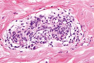 Fig. 4, Reactive angioendotheliomatosis.