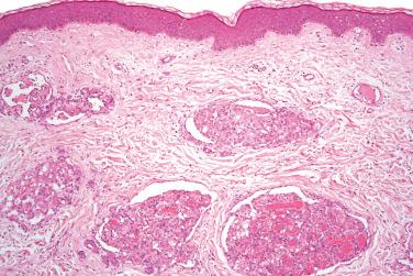 Fig. 2, Glomeruloid hemangioma.