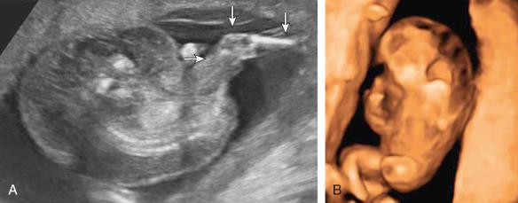 Fig. 163.1, (A) A 16-week, 2-day, acardiac twin within a monochorionic-diamniotic twin reversed arterial perfusion (TRAP) pair. Arrows demonstrate a lower extremity. (B) Three-dimensional view of a 15-week, 1-day acardiac twin within a monochorionic-monoamniotic TRAP pair.