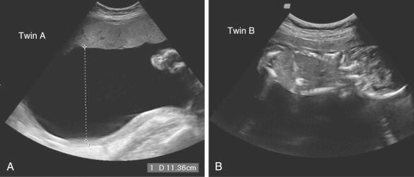 Fig. 162.2, Image of monochorionic diamniotic twins with TTTS shows polyhydramnios in the recipient's sac (A), whereas the donor (B) was stuck to the anterior uterine wall owing to marked oligohydramnios.