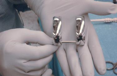 FIGURE 33A.2, Metal runners for the femoral component of the articulating joint prosthesis.