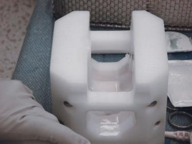 FIGURE 33A.5, The mold housing supports the implant while it is setting, allowing the surgeon to compress the bone surface mold into the base mold.