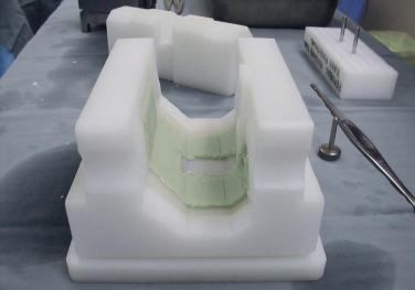 FIGURE 33A.8, The completed femoral component is allowed to completely harden.